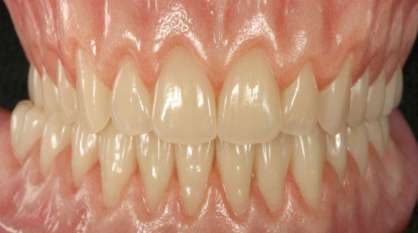 Real Life Denture By Dr Paul Moore - Gate Dental Clinic Galway Real Life Denture By Dr Paul Moore - Gate Dental Clinic Galway