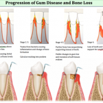 Gum disease and bone loss